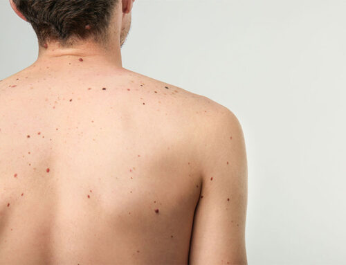 Melanoma and Skin Cancer Awareness Month