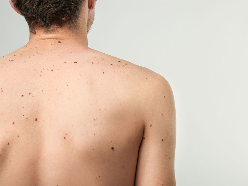 Cosmetic Insure Map My Mole