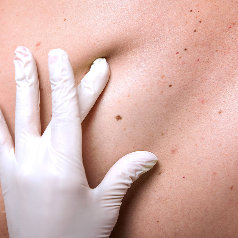 CosmeticInsure-Melanoma2-800×800 Cosmetic Insure Map My Mole